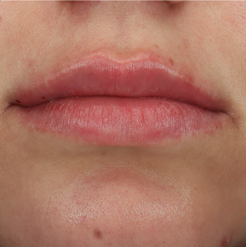 Lippen na lipfillers