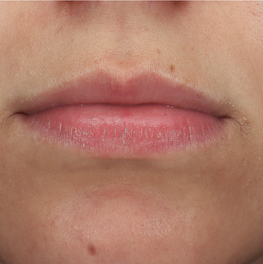 Lippen voor behandeling met fillers