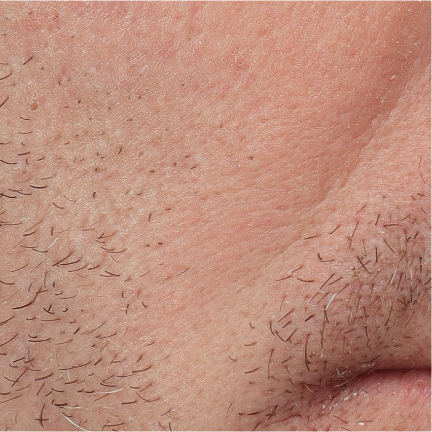 Vergrote porien 2 after