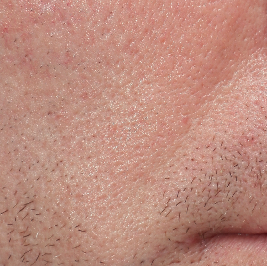 Vergrote porien 2 before