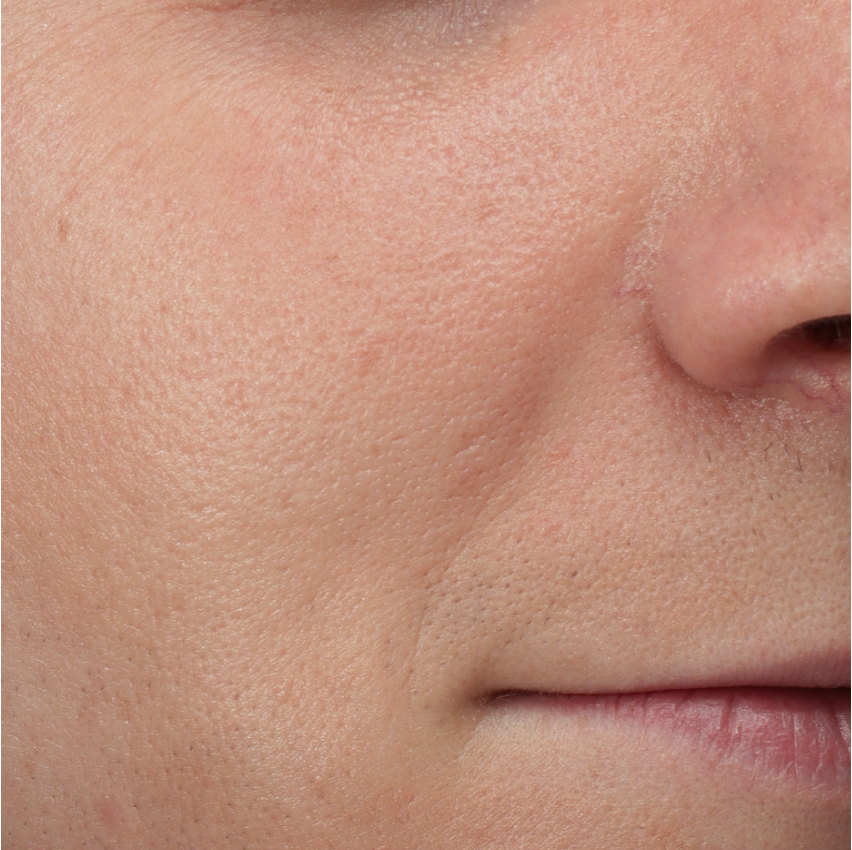 Huid van een jongeman met een neus-lippenplooi voor behandeling met Fillers