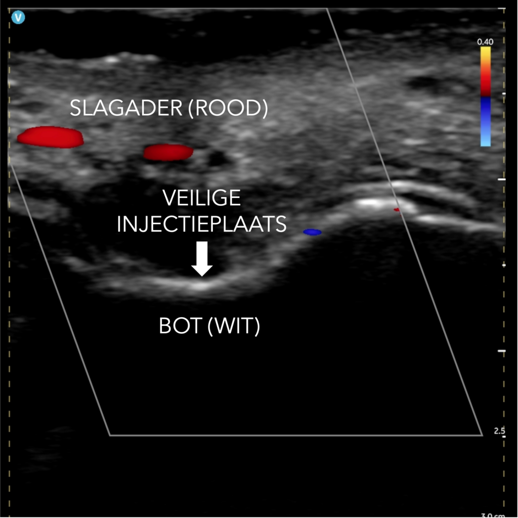 Echografie foto van de huid