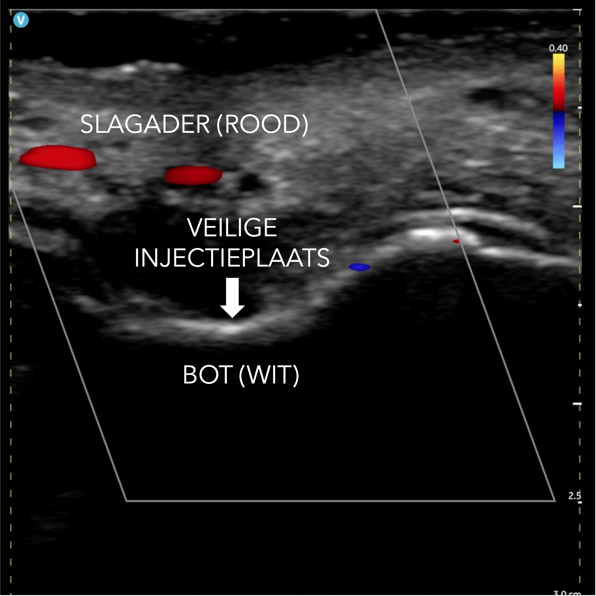 Echografie foto van de huid