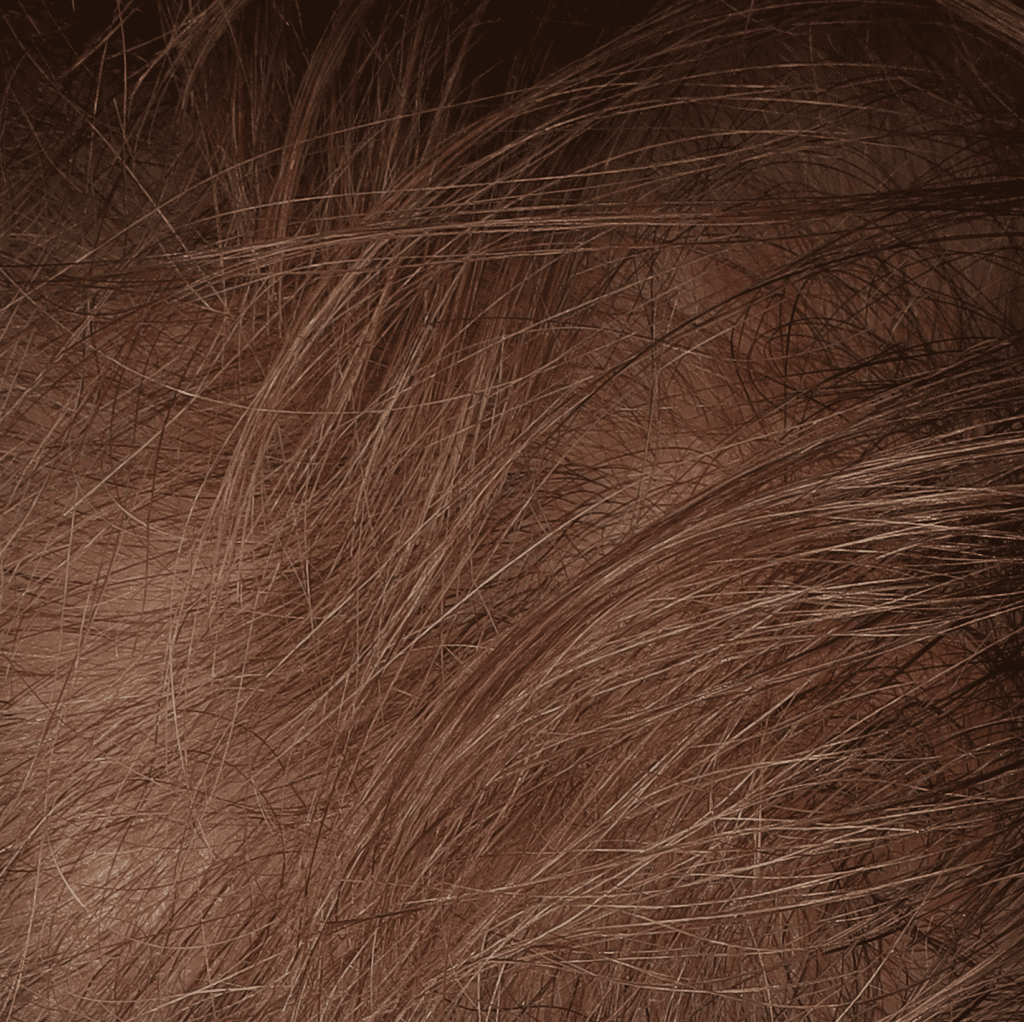 Alopecia Androgenetica aantal weken na behandeling bij Kliniek Ebbelaar (ingezoomd)