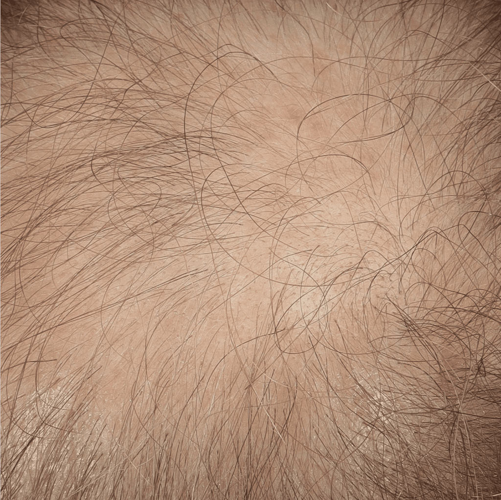 Alopecia Androgenetica voor behandeling bij Kliniek Ebbelaar (ingezoomd)