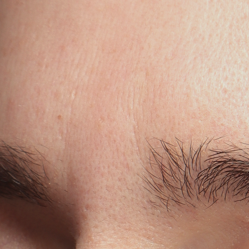 FACETOX - Pt 3 - BEFORE