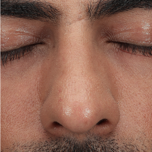 Neus na behandeling met botuline toxine, resultaat is een neus met kleinere poriën