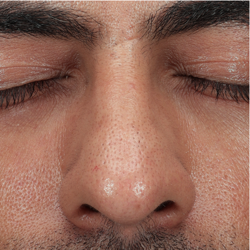 Neus voor behandeling met botuline toxine, met zichtbare poriën