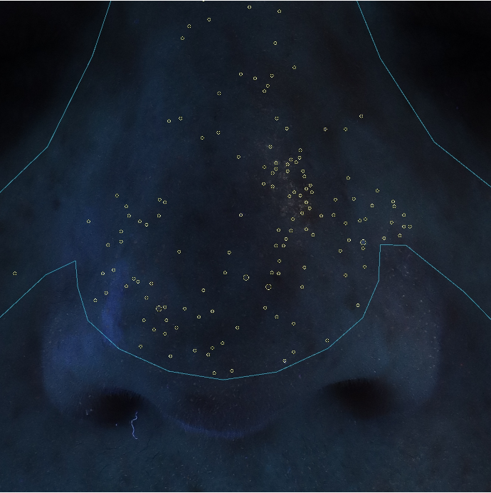 Nosetox porfyrines na behandeling met botuline toxine