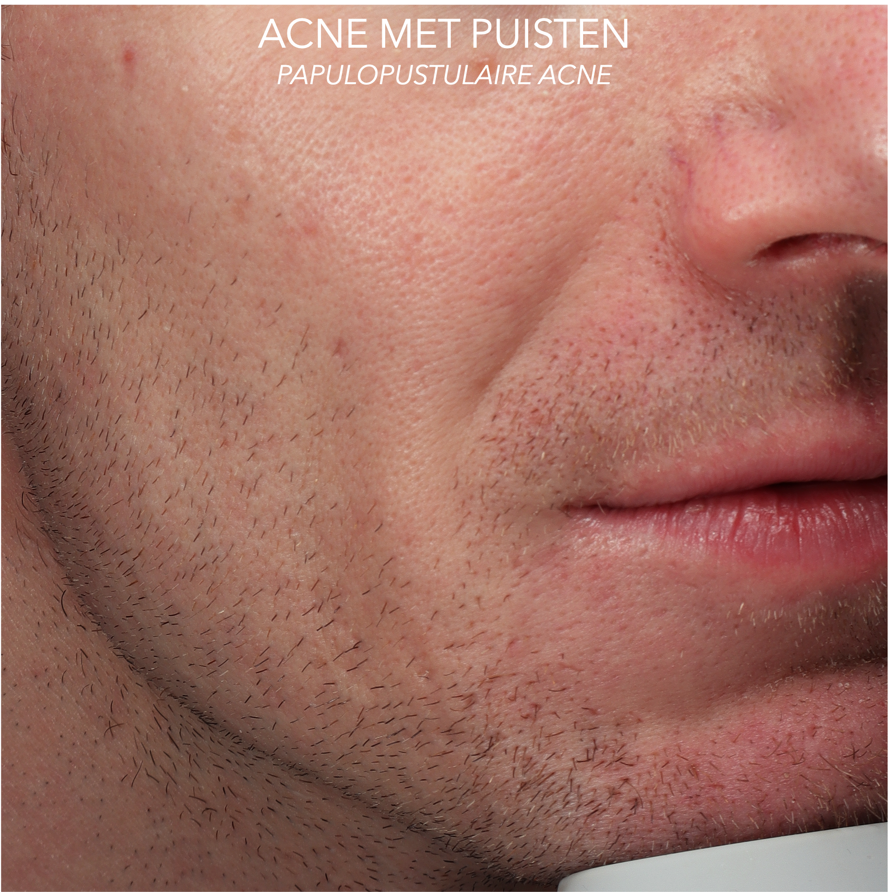 ACNE MET PUISTEN EN PUKKELS GEZICHT (PAPULOPUSTULAIRE ACNE) NA BEHANDELING