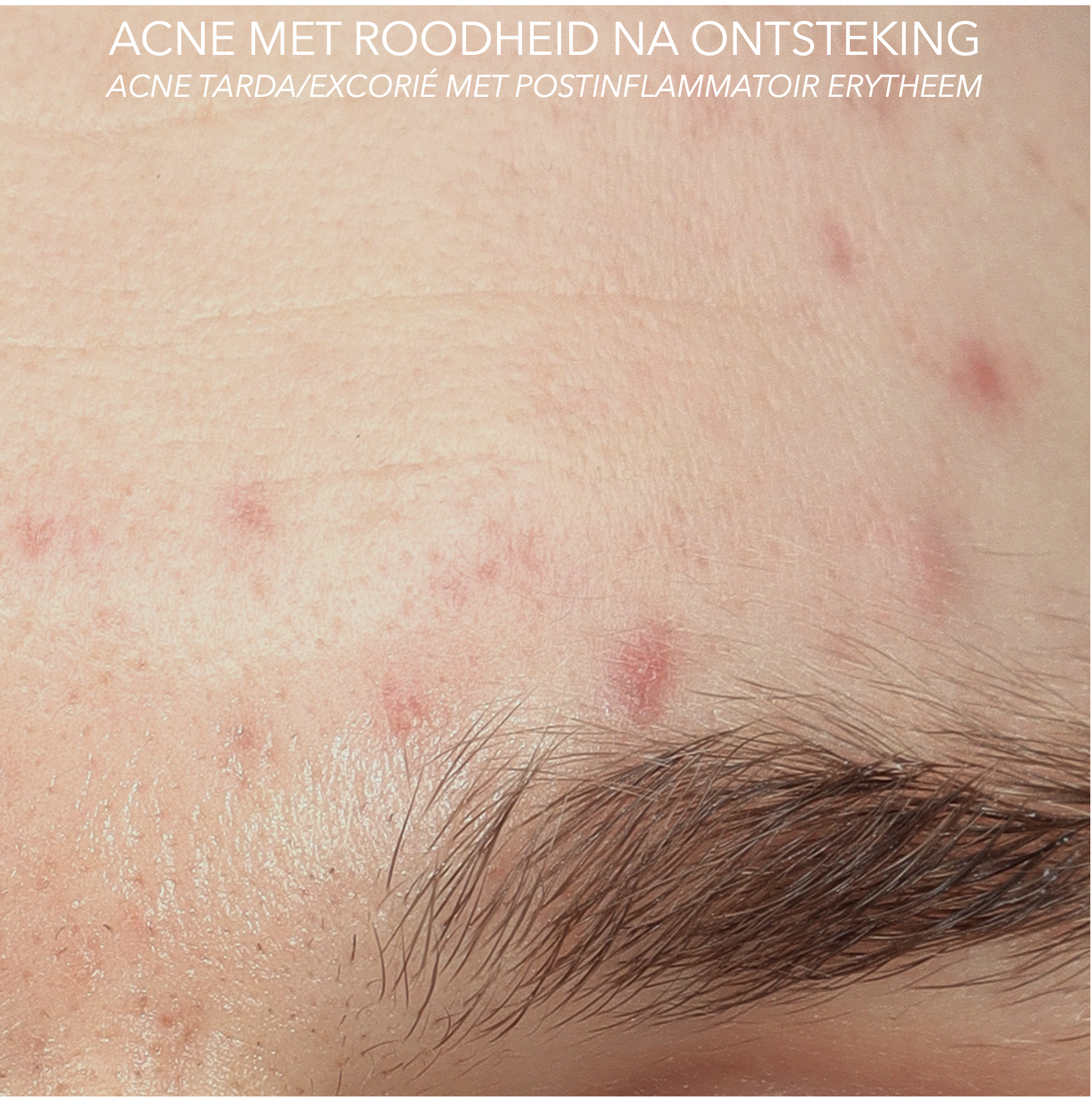 ACNE TARDA GEZICHT MET POSTINFLAMMATOIR ERYTHEEM VOOR BEHANDELING