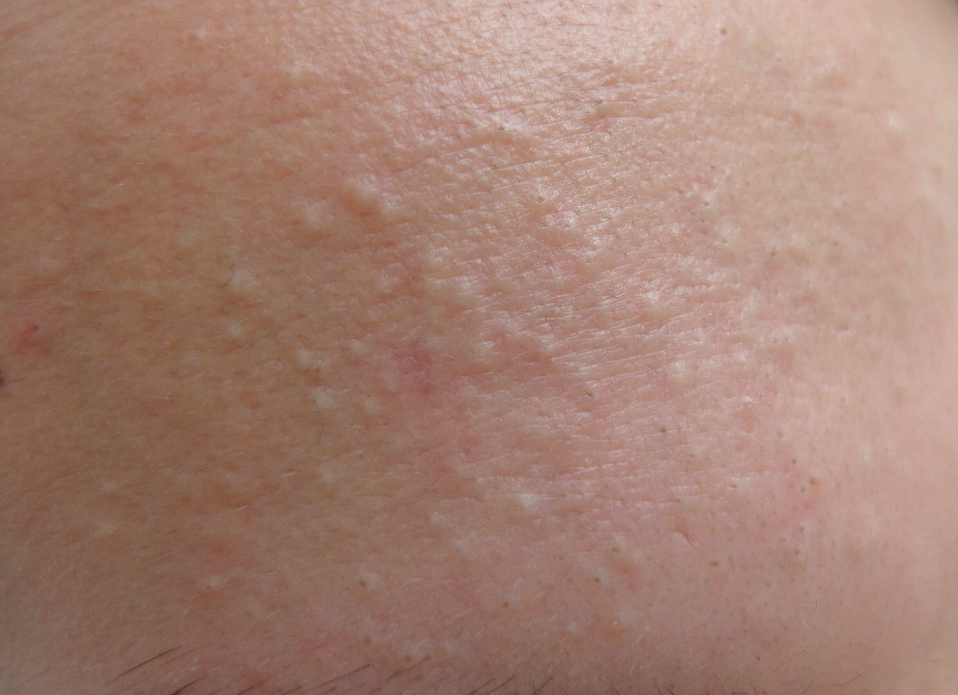 Acne en littekens
