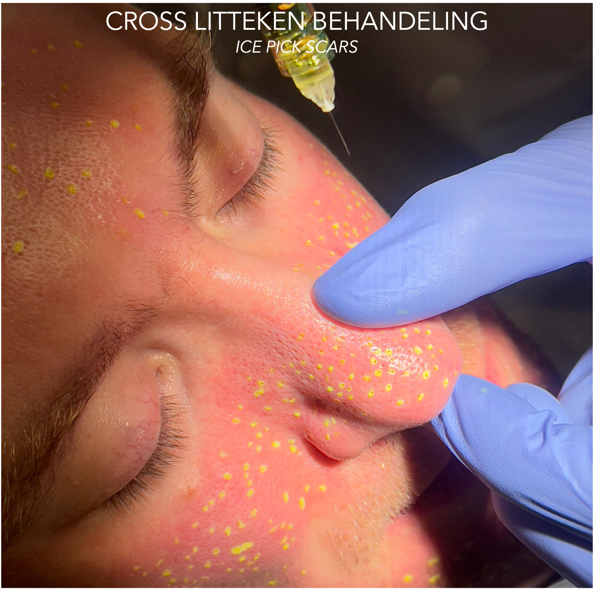 Behandeling van acne littekens van het ice pick scar type in het gelaat met CROSS (trichloorazijnzuur)