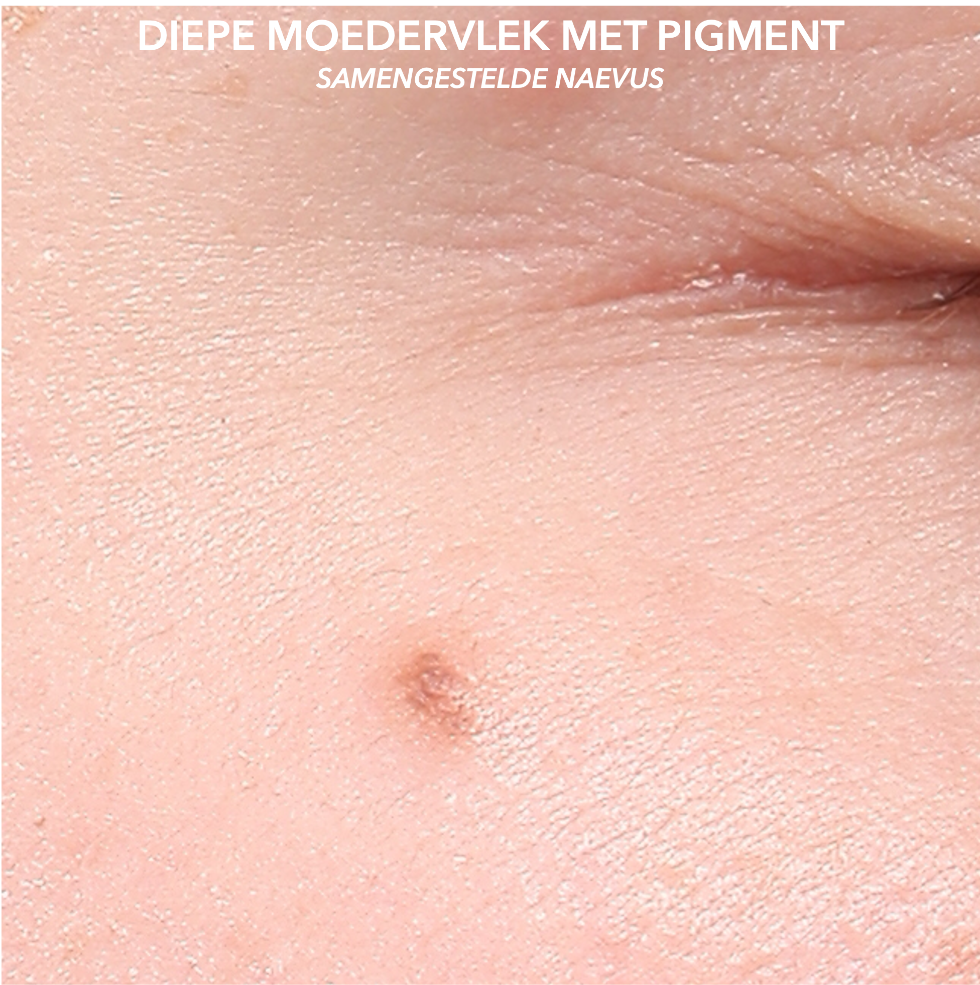 Samengestelde naevus