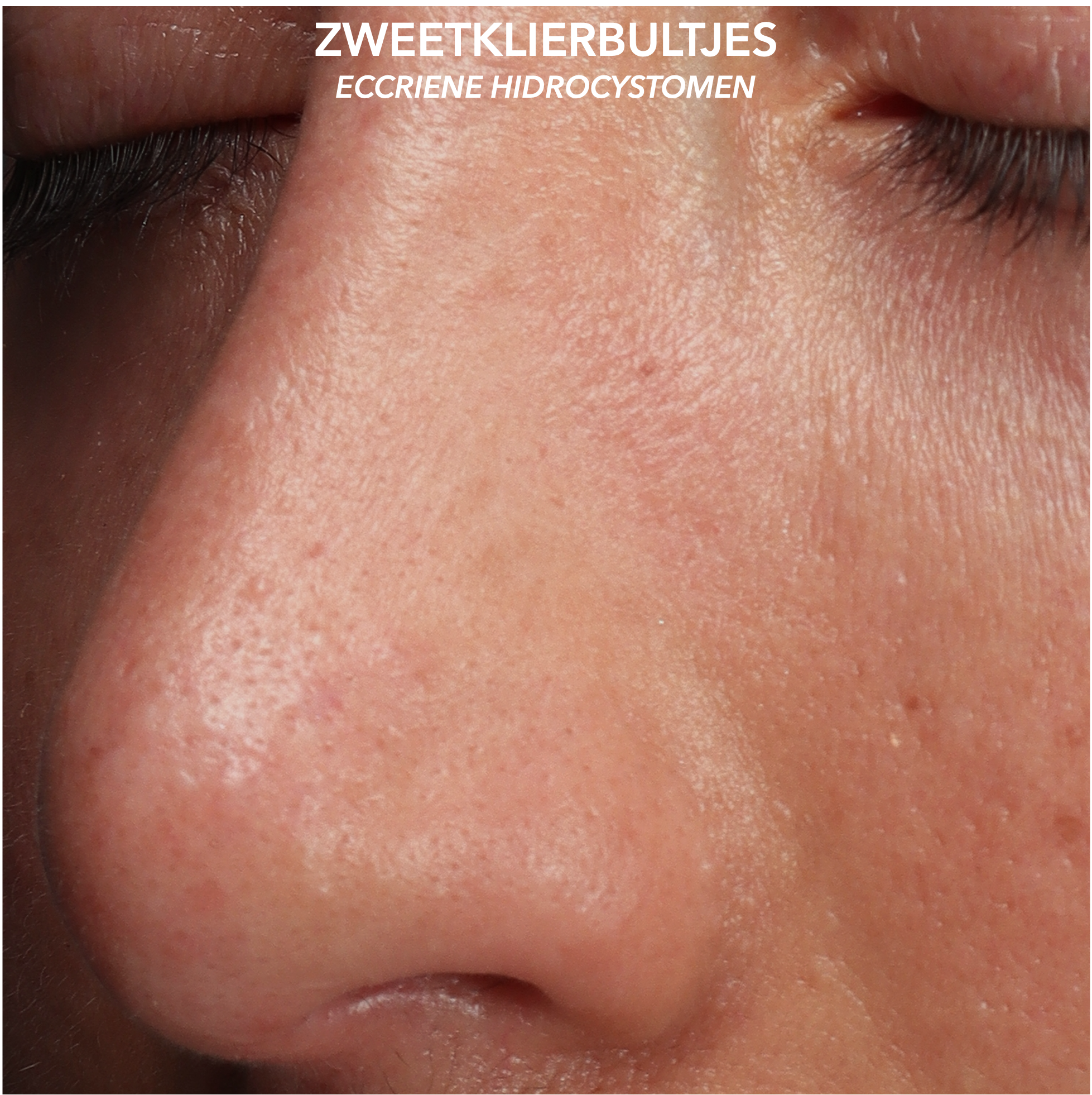 Zweetklierbultjes op de neus na behandeling met botuline toxine en cryotherapie