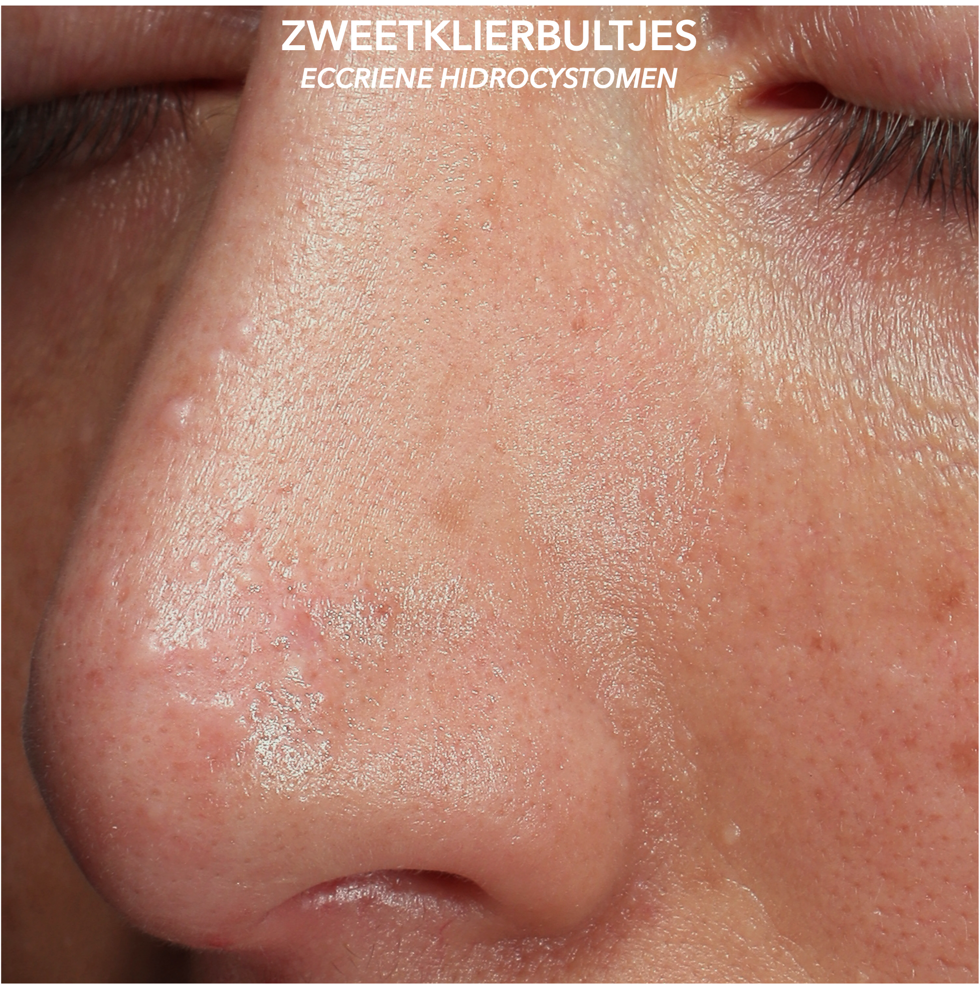 Zweetklierbultjes op de neus voor behandeling met botuline toxine en cryotherapie