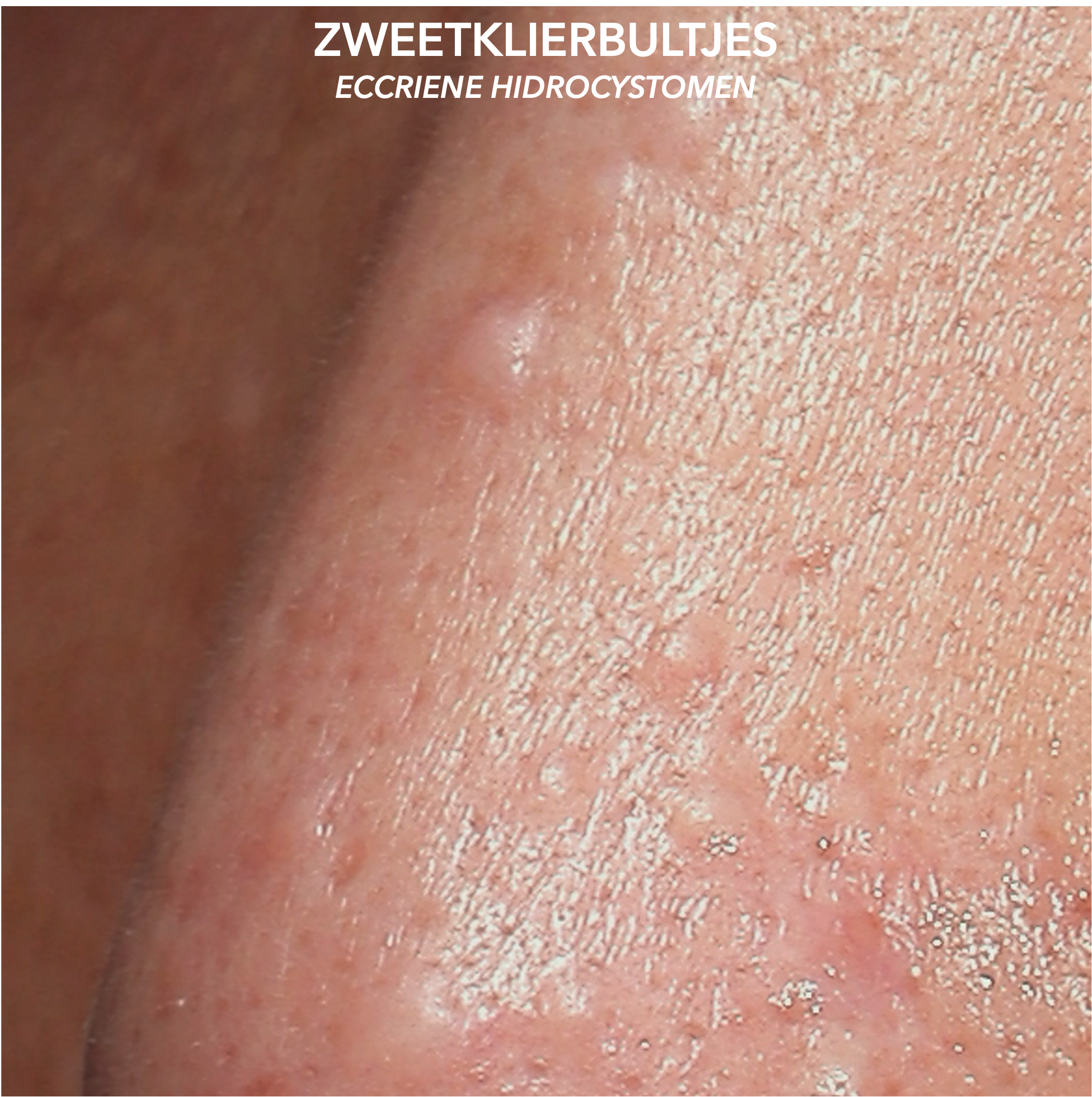 Zweetklierbultjes op de neus voor behandeling met botuline toxine en cryotherapie - close-up