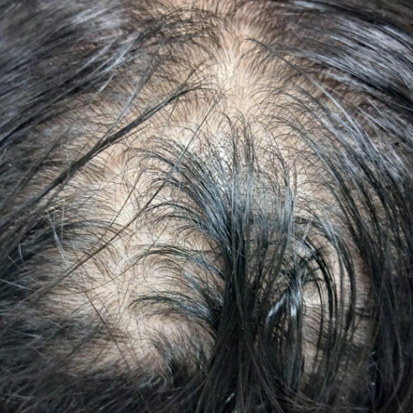 Verminderde haarinplant