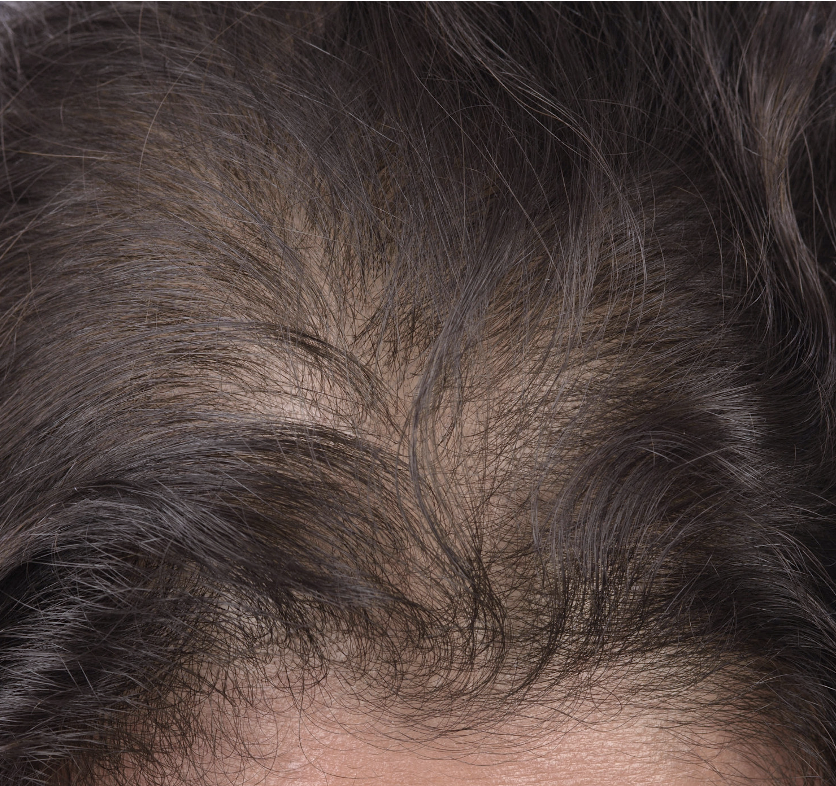 Behoud voorste haargrens