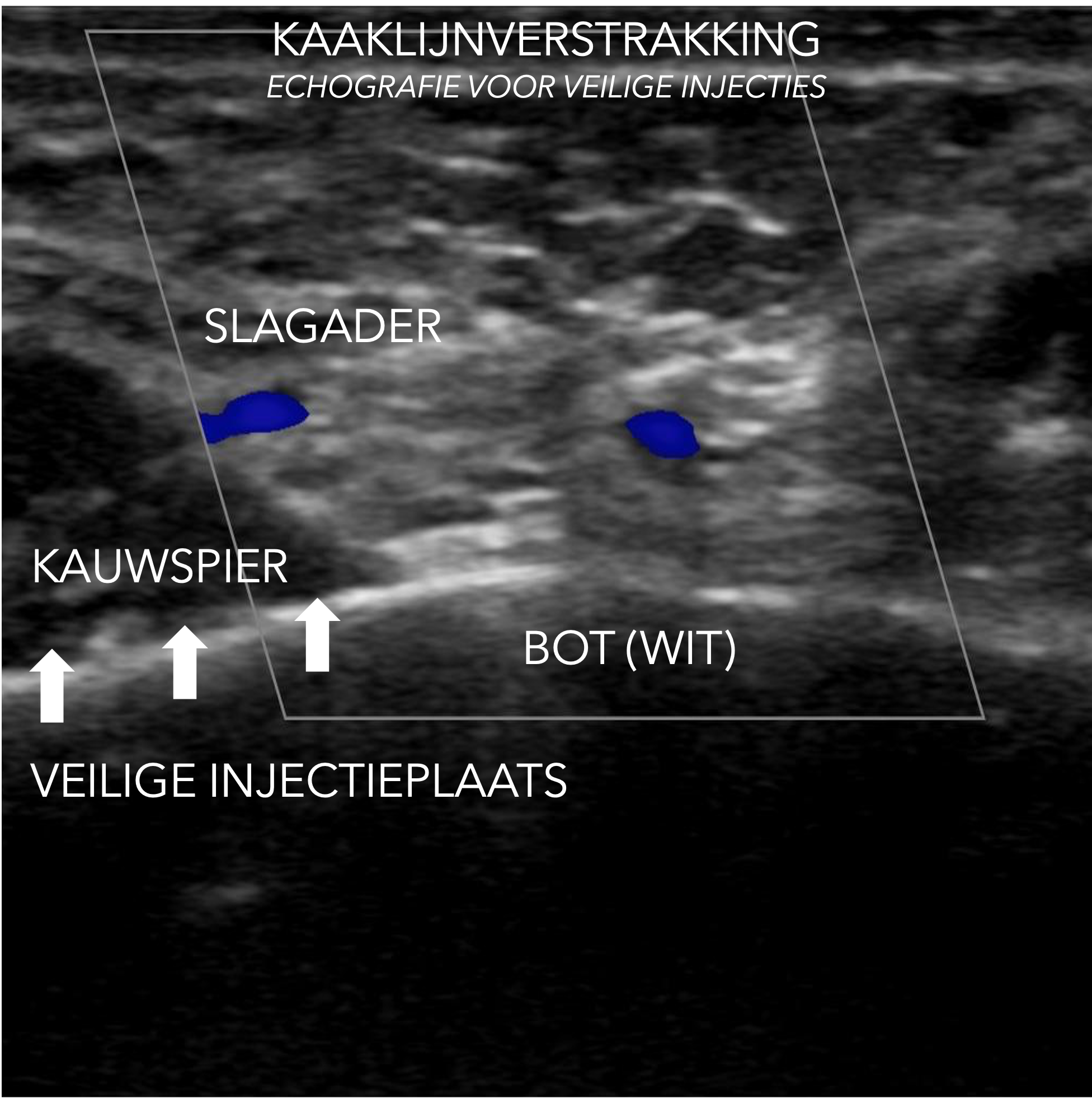 ECHOGRAFISCH BEELD VAN DE KAAKLIJN OM VEILIGHEID VAN FILLERINJECTIE TE VERGROTEN