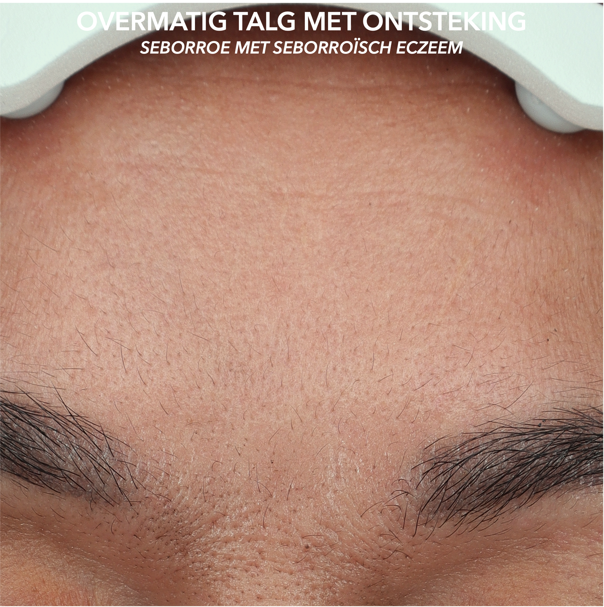 MICROTOX - SEBORROE - AFTER