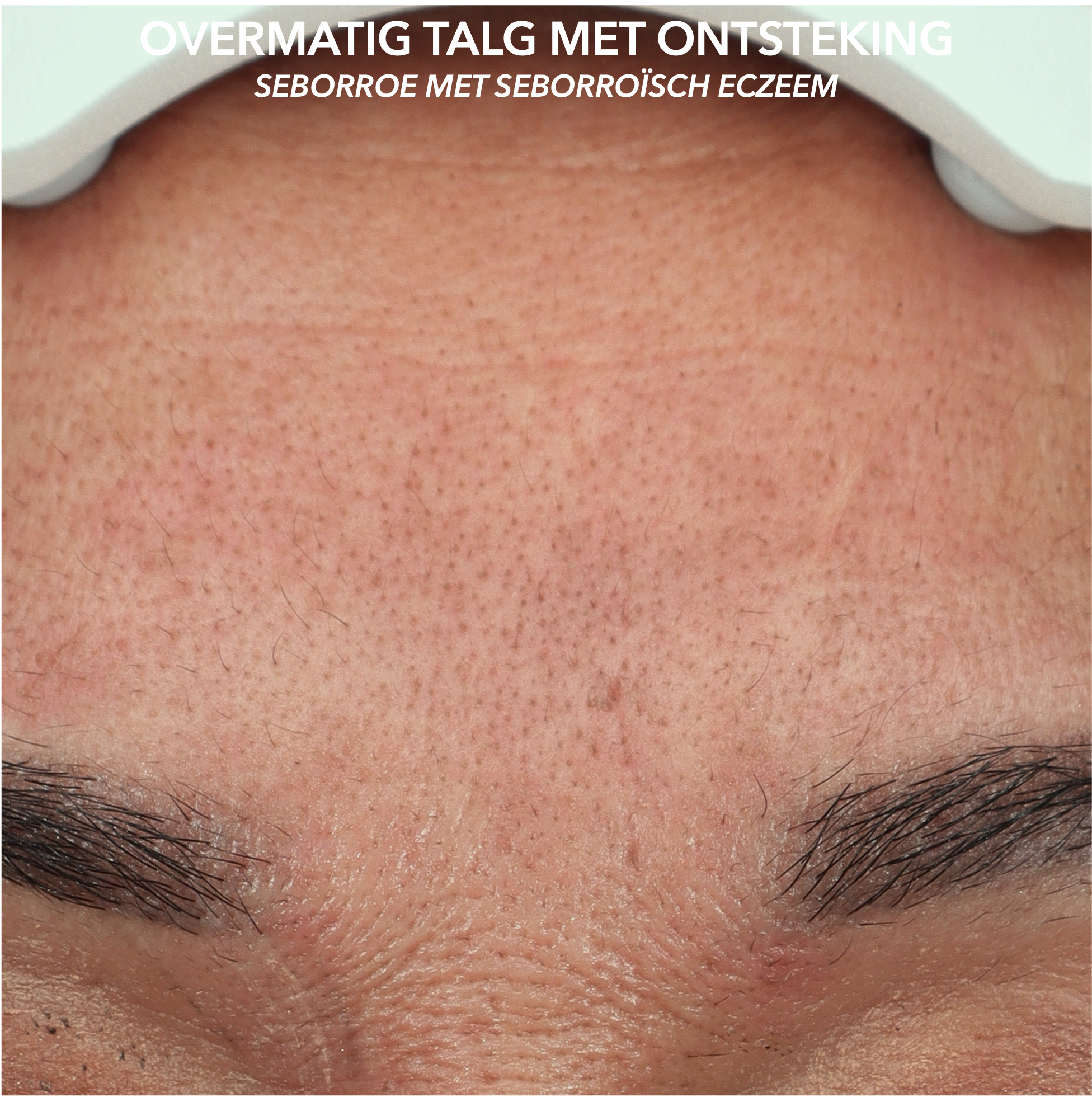 MICROTOX - SEBORROE - BEFORE