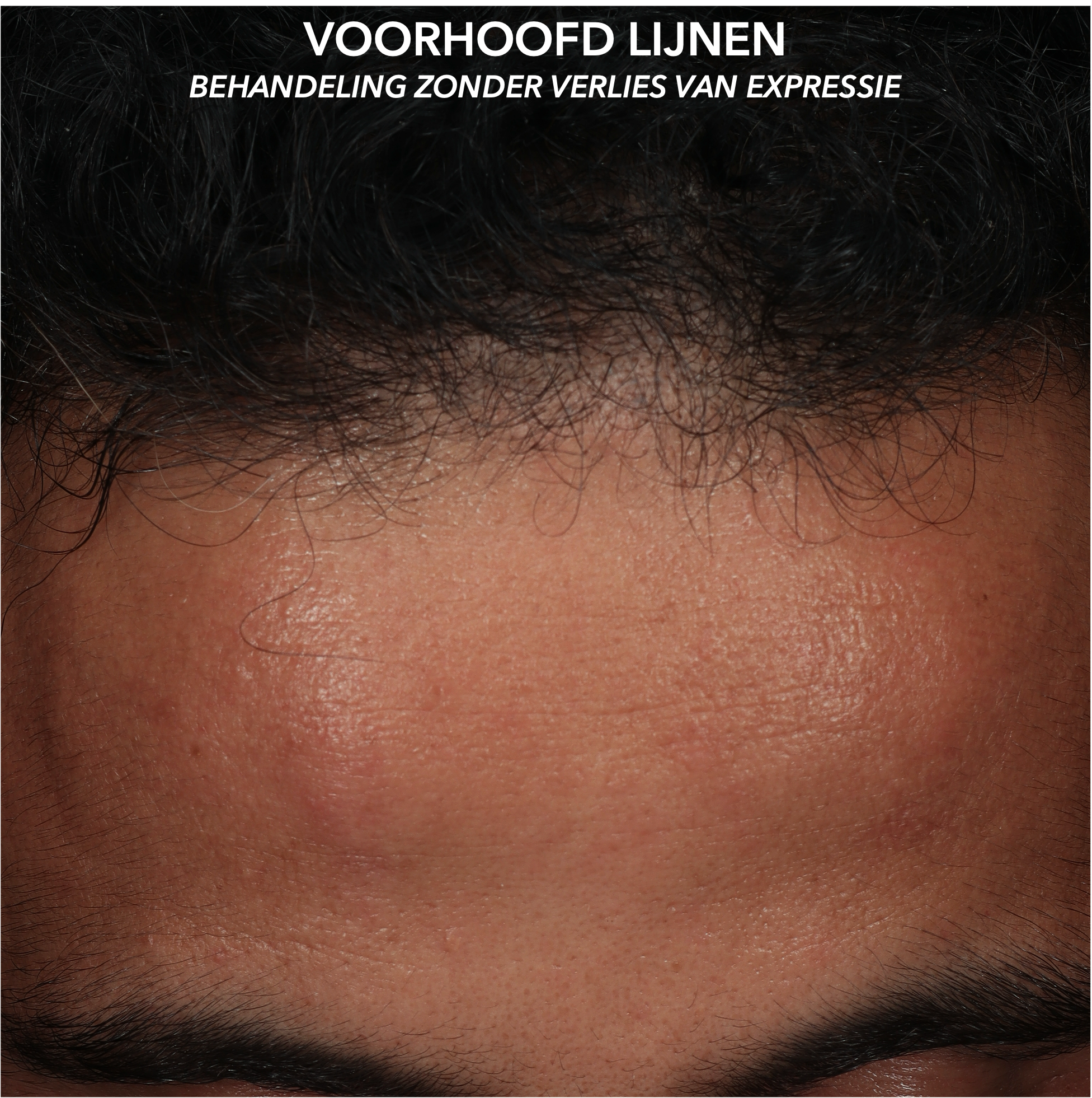 MICROTOX - VOORHOOFDSLIJNEN - AFTER