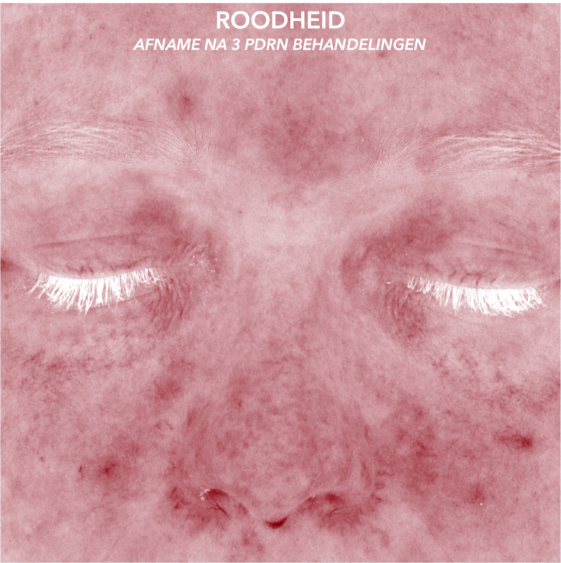 PDRN ROODHEID BEFORE