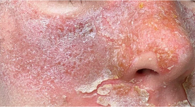 Tijdelijke bijwerkingen