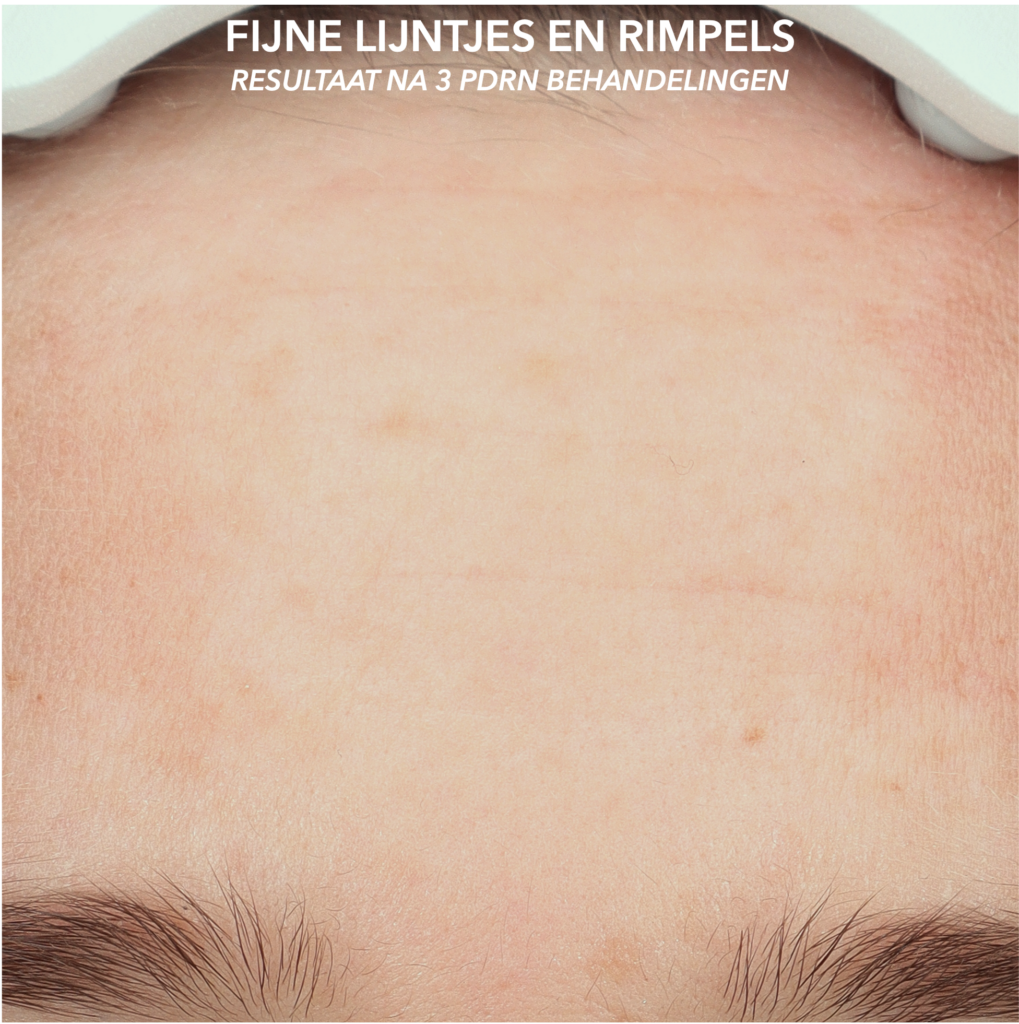 Effect van polynucleotiden op fijne lijntjes en rimpels in het gezicht na driemaal behandeling