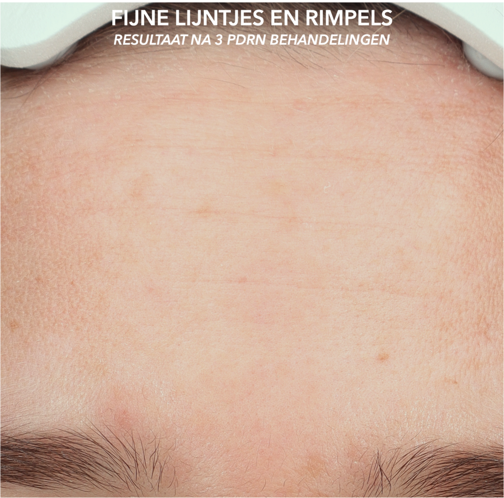 Effect van polynucleotiden op fijne lijntjes en rimpels in het gezicht voor driemaal behandeling