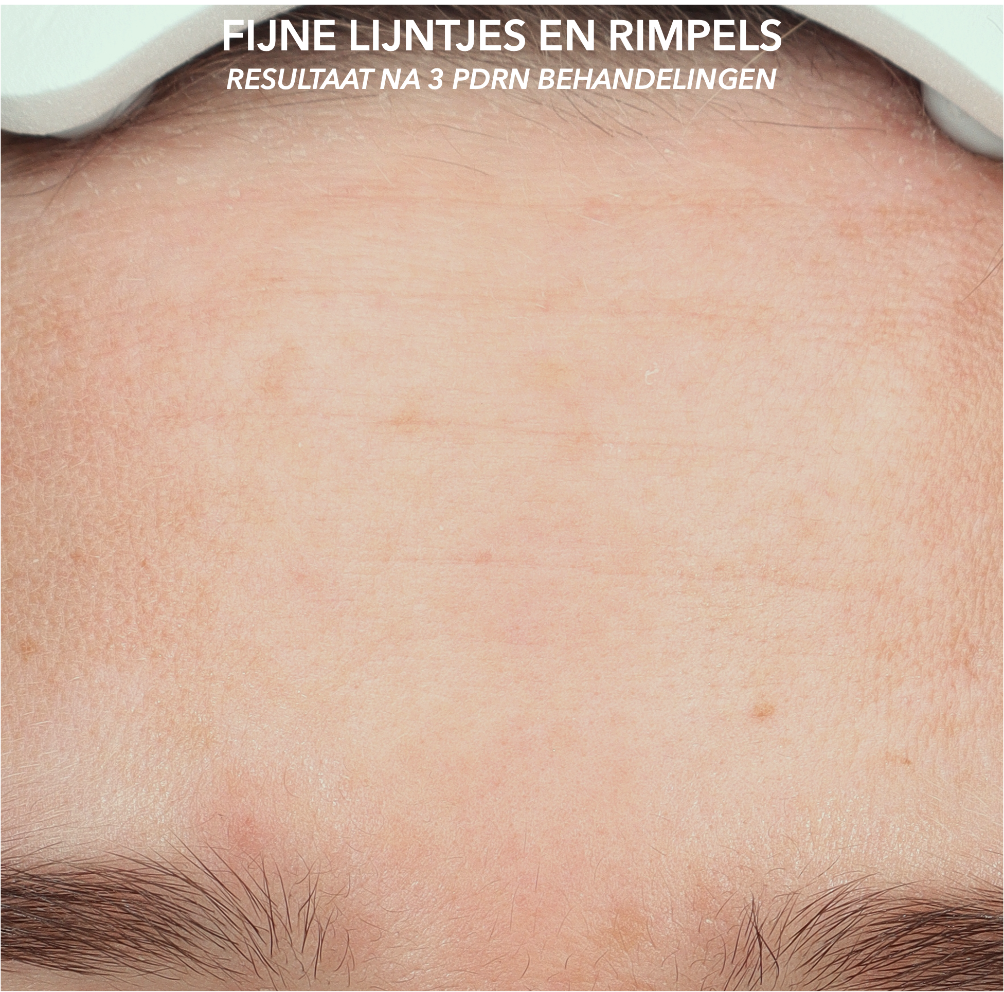 Effect van polynucleotiden op fijne lijntjes en rimpels in het gezicht voor driemaal behandeling