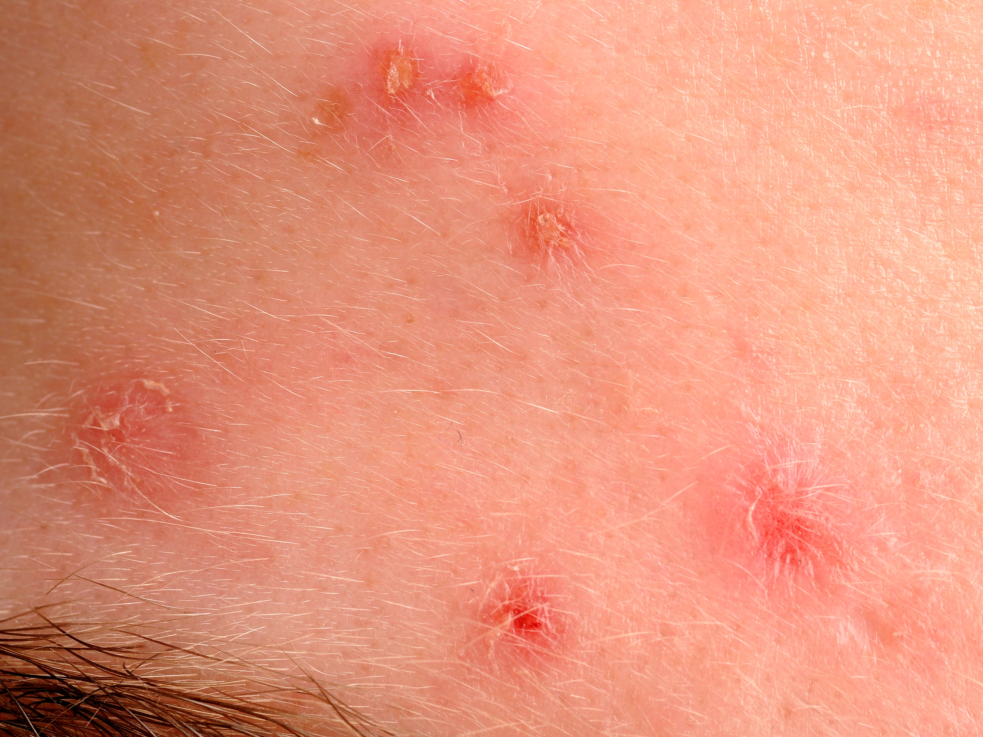 Acne excoriée