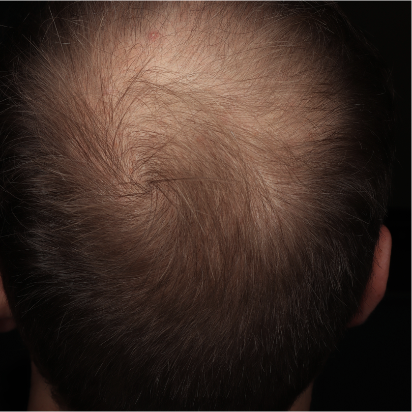 ALOPECIA ANDROGENETICA BEFORE Y