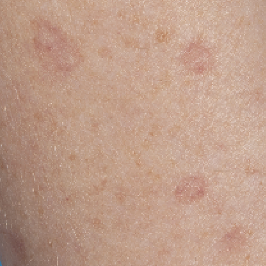 Gedissemineerde superficiële porokeratose