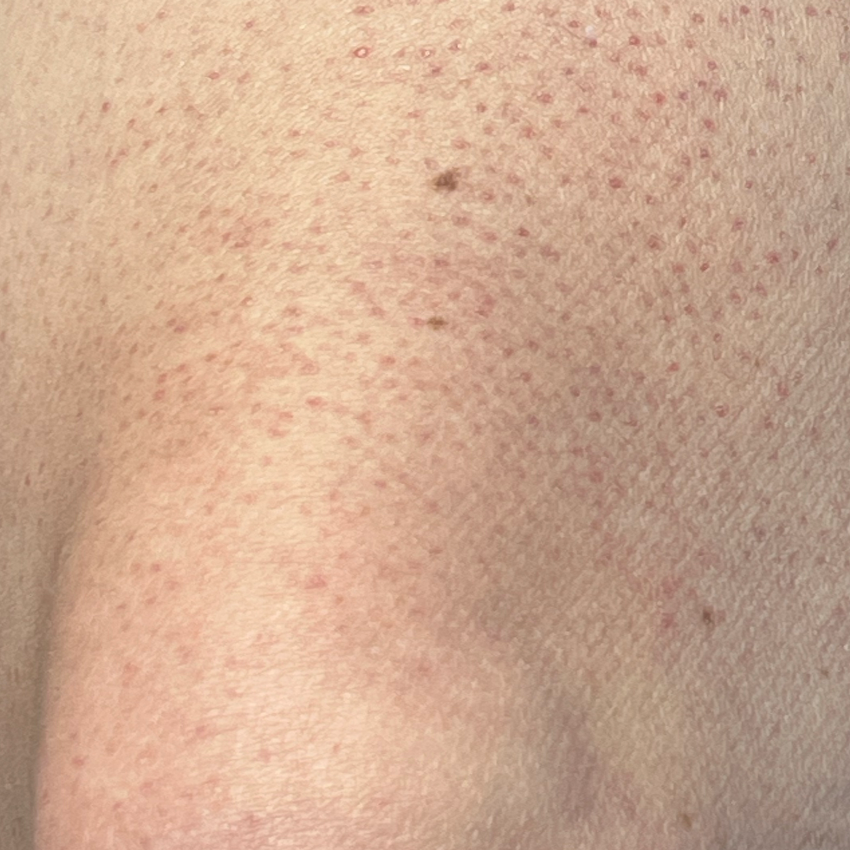 Keratosis pilaris