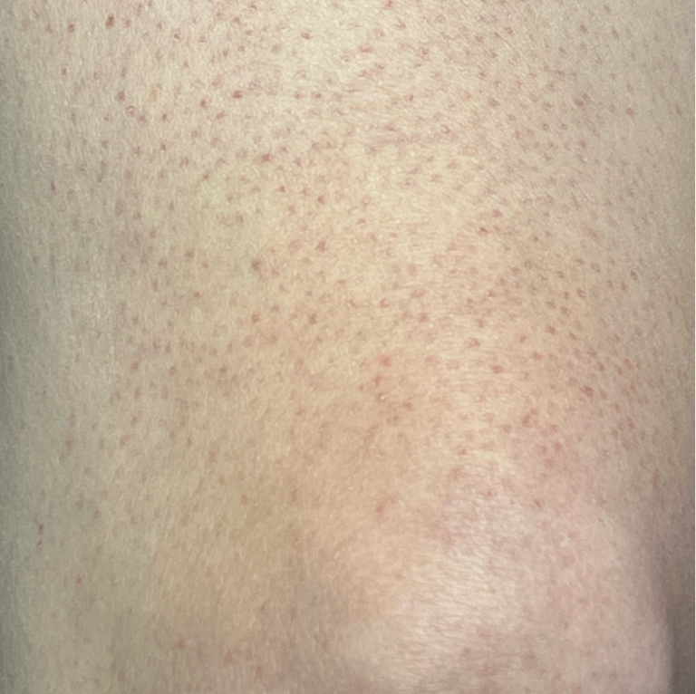 Keratosis pilaris ingezoomd