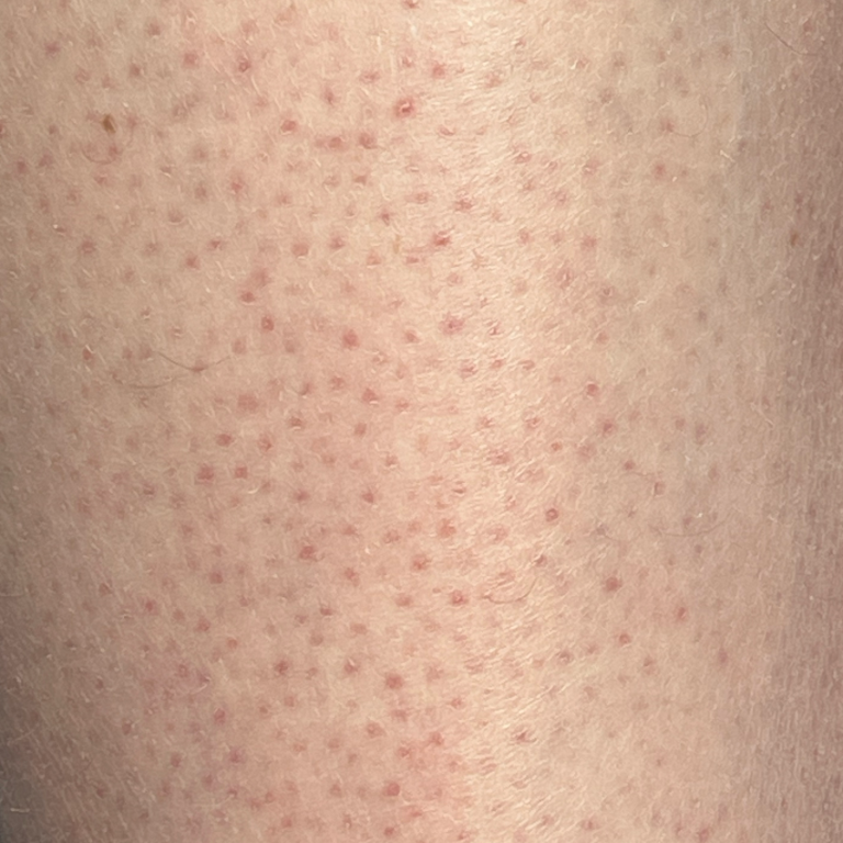 Keratosis Pilaris been
