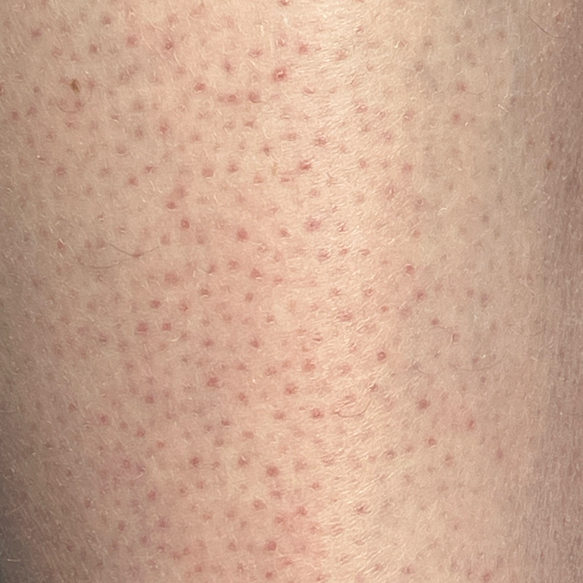 Keratosis pilaris