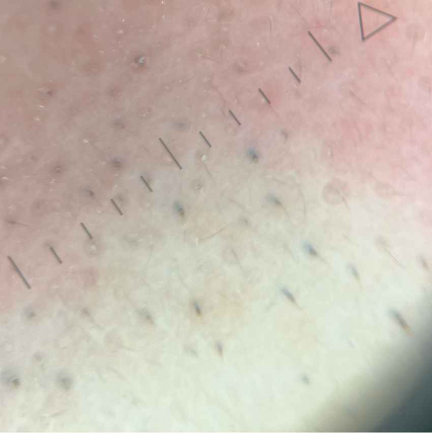 Trichostasis spinulosa ingezoomde foto