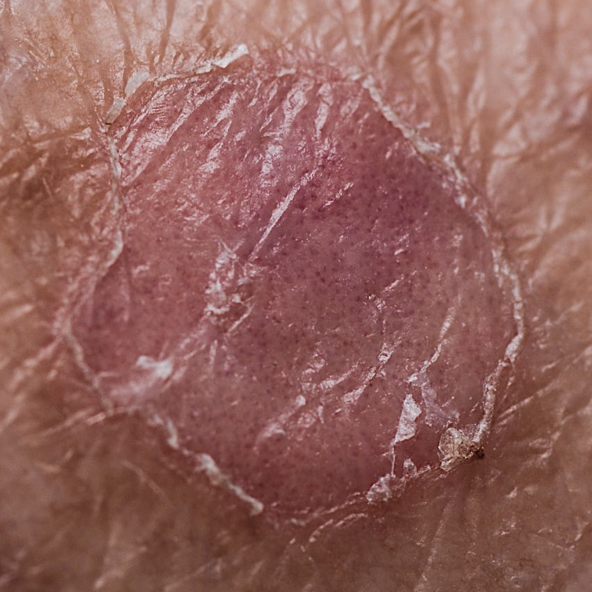 Porokeratose van Mibelli