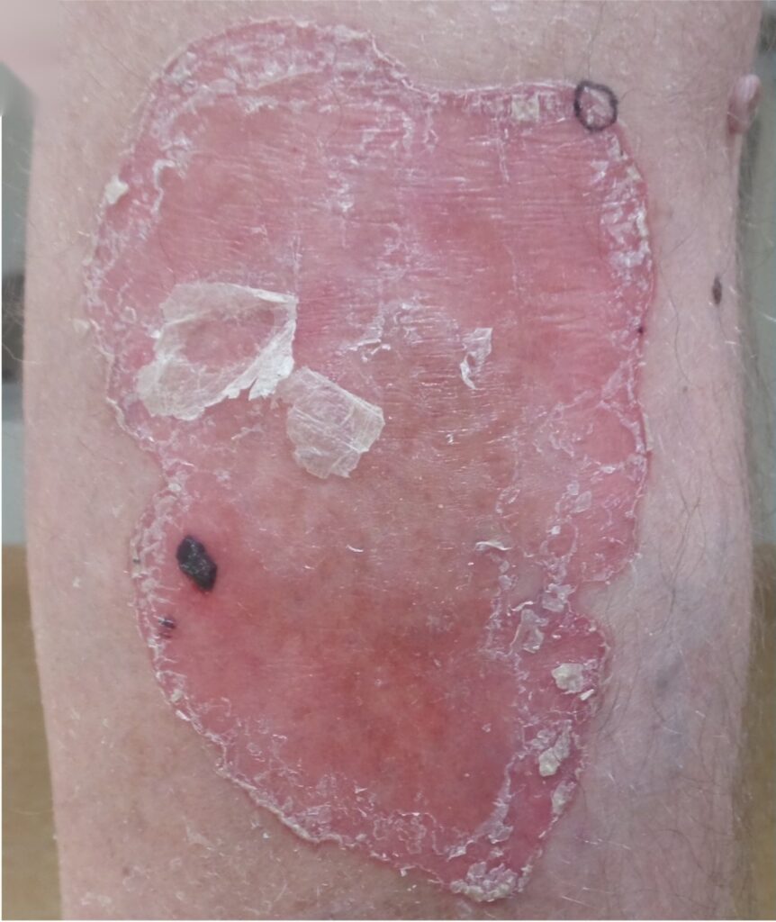 Porokeratose op het onderbeen voor behandeling