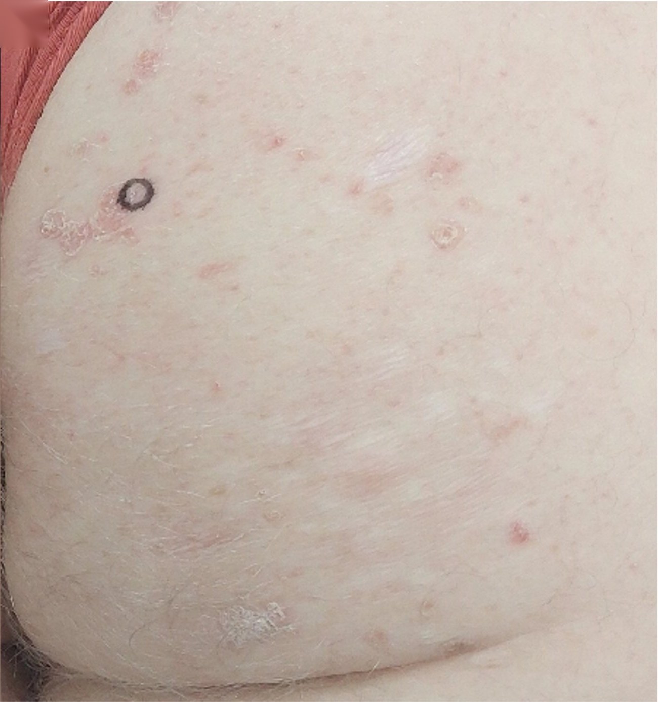 Porokeratosis ptychotropica